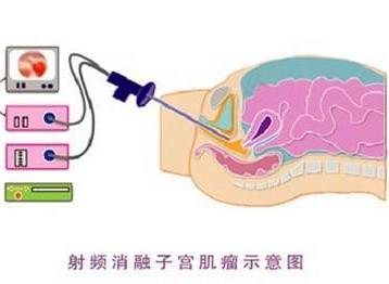 心脏射频消融术