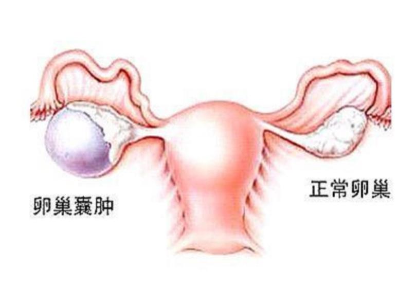 生理性囊腫