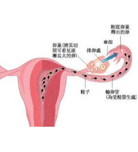 输卵管介入复通术