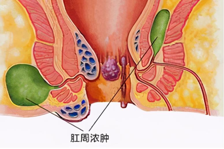 肛周膿腫