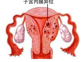 盆腔子宫内膜异位症