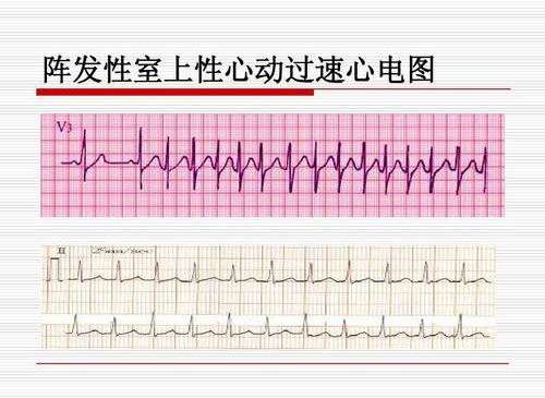 陣發性室上性心動過速