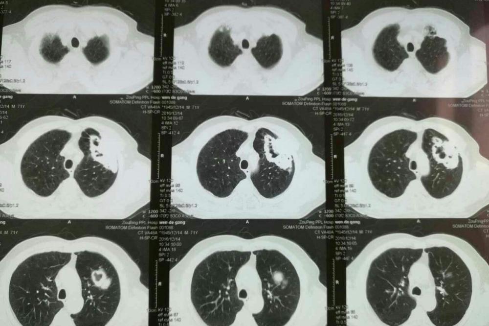 肺鱗癌