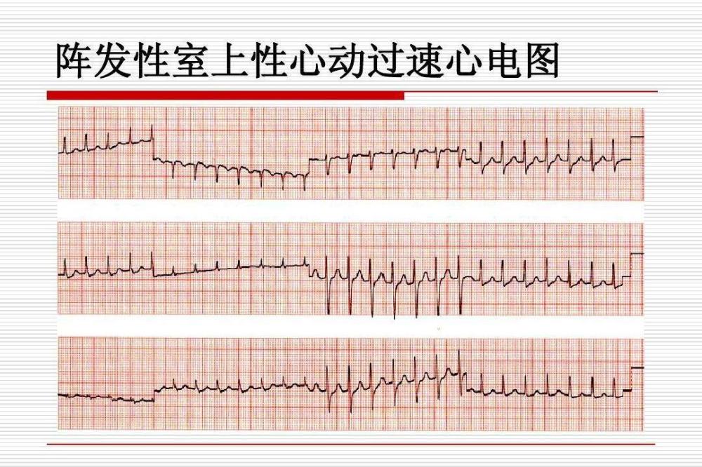 室上性心动过速