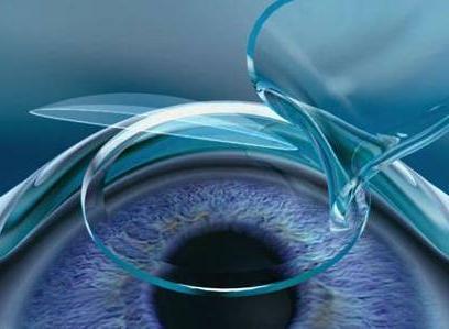 準分子激光治療近視手術