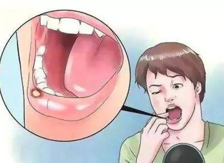 口腔粘膜白斑病