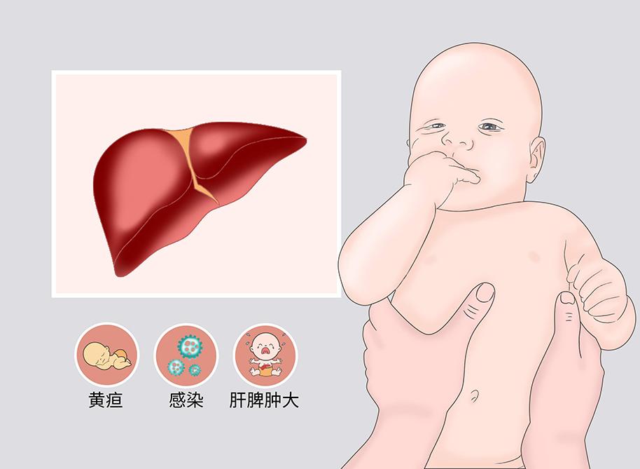 婴儿肝炎综合征