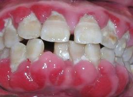 牙龈腫脹