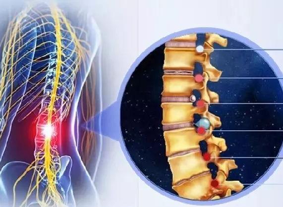 腰椎间盘突出偏方