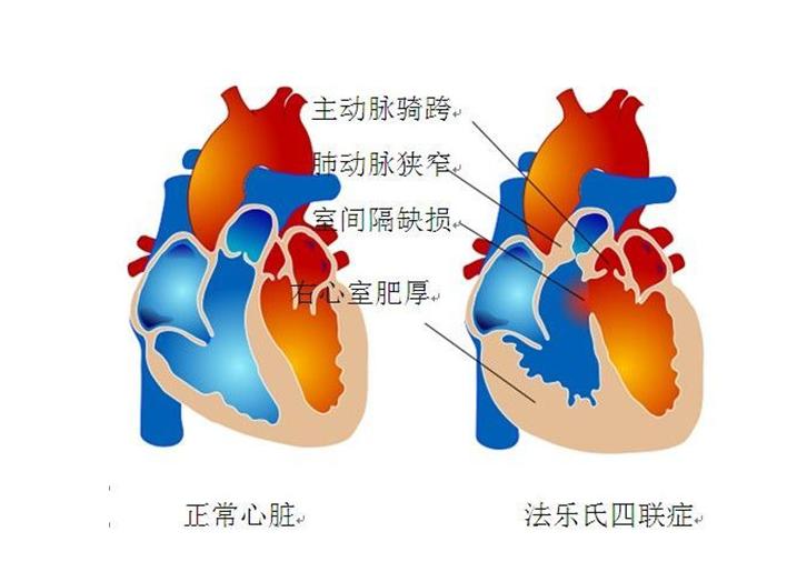 法洛四联症