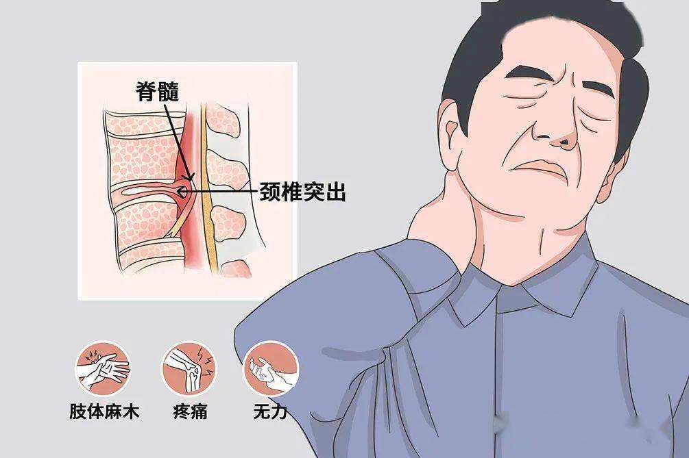 脊髓型颈椎病