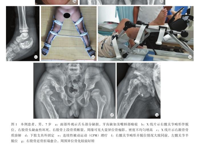 先天性无痛无汗症