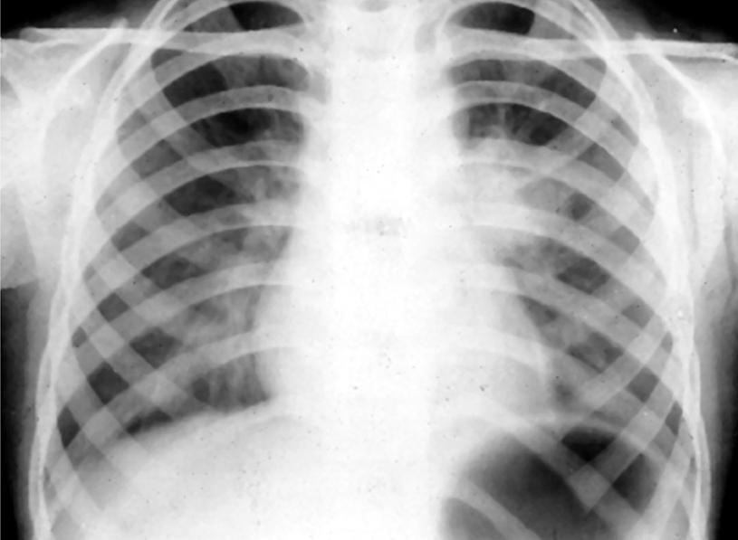 肺门淋巴结核