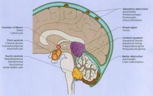 流行性脑脊髓膜炎