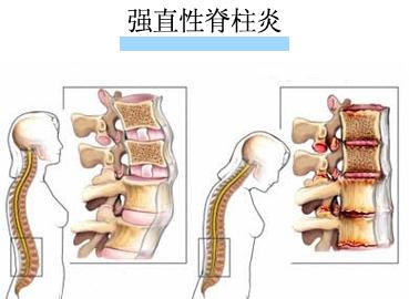 强直性脊椎炎