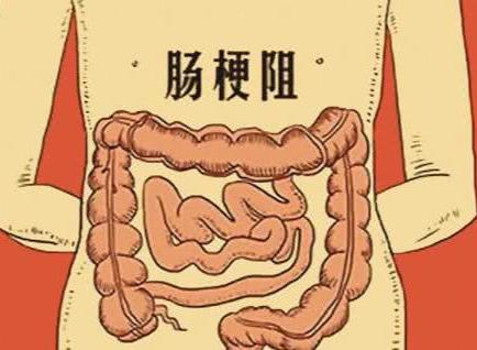 腸阻梗