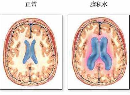 交通性脑积水