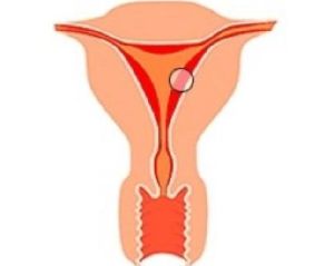 子宮内膜厚
