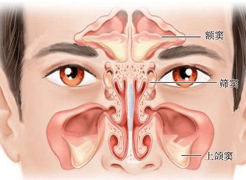 慢性筛窦炎