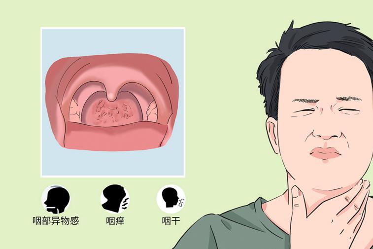 慢性單純性咽炎